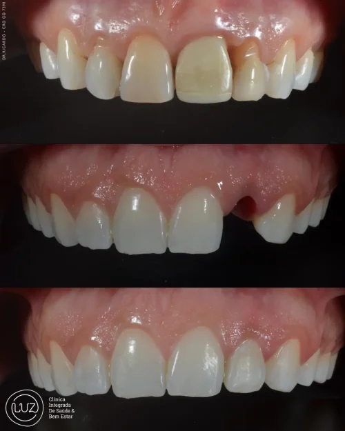 MODELO DE ANTES E DEPOIS 10