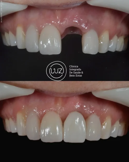 MODELO DE ANTES E DEPOIS 11