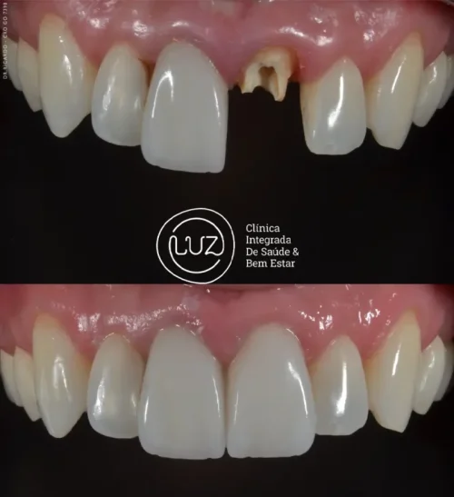 MODELO DE ANTES E DEPOIS 16